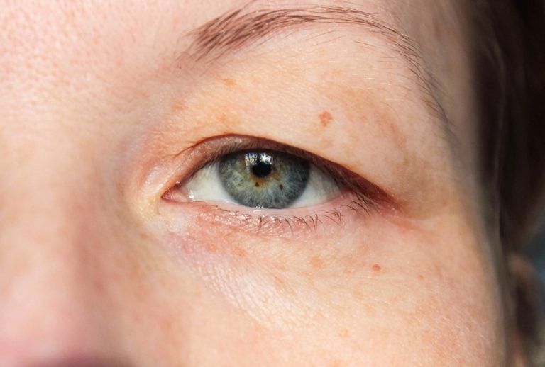How To Treat Ptosis? The Causes And Cures