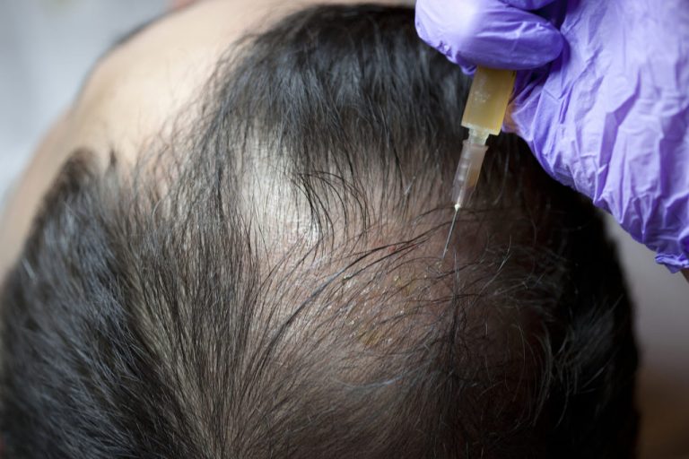 Why Rely Upon PRP Treatments for Hair Loss?