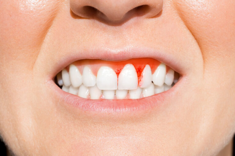 What are the most common periodontal diseases? Check out the list!